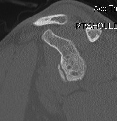 Revision Shoulder Stabilisation Bony Defect 2